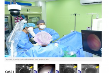 회전근개파열 치료 새 패러다임..굳센병원,'리제네텐'재…